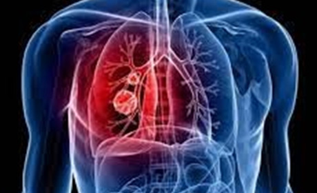 Туберкульоз: небезпека, яка стосується кожного, і яку можемо подолати разом