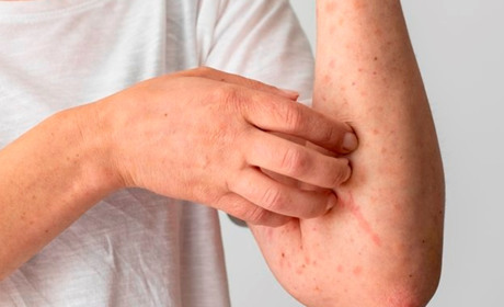 В Україні зафіксовано спалах кіру. Що робити, щоб не заразитися