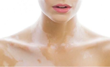 Вітиліго: чому виникає, чи є можливість вилікувати захворювання