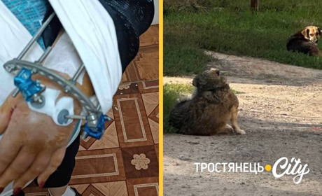 Скільки людей уже постраждало. Через напад собак мешканка Тростянця зламала руку і лежить у лікарні