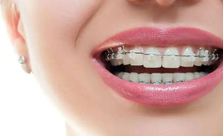 Методи й типи вирівнювання зубів у дорослих: особливості