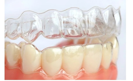 Що таке елайнери