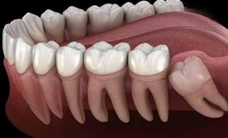 Атипове видалення зуба: що це таке і коли потрібне?