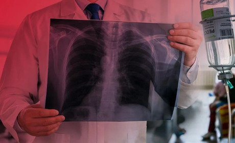 Гадяччина перевищила епідемічний поріг захворювання на туберкульоз