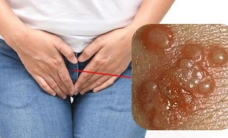 Генітальний герпес: причини, симптоми та ефективні методи лікування