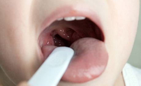 Видалення аденоїдів у дітей: показання, підготовка та відновлення