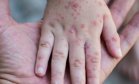 «Непомітний, але небезпечний»: що потрібно знати про вірус коксакі