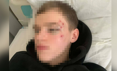 Побиття кастетом хлопця у Переяславі поліція перекваліфікувала на ушкодження середньої тяжкості