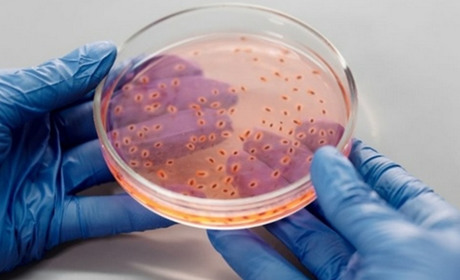 Чому кандидоз виникає: основні причини та фактори ризику