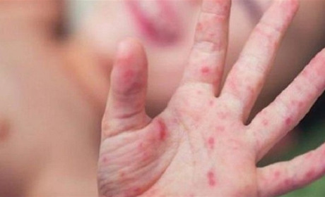 З початку року на Калиніщині на кір захворіло більше 100 осіб