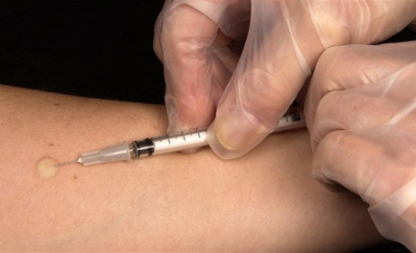 Замість проби Манту: Україна переходить на нові методи виявлення туберкульозу