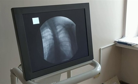 На Хмельниччині додалось за місяць 55 хворих туберкульозом, серед них є і діти