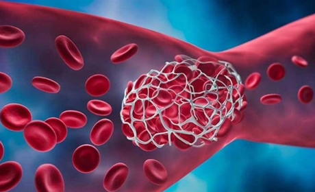 Тромбоз: симптоми, причини та профілактика захворювання