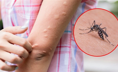 Небезпечні комахи навесні: потенційні епідемічні ризики та заходи контролю