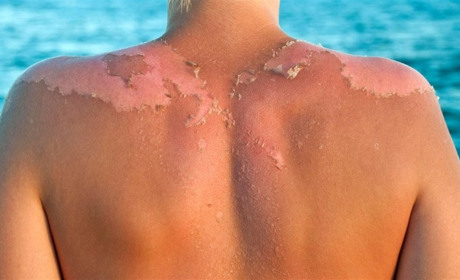 Як запобігти сонячним опікам і що робити, якщо уникнути опіку не вдалося