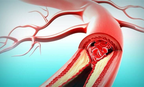 Ефективні методи очищення судин