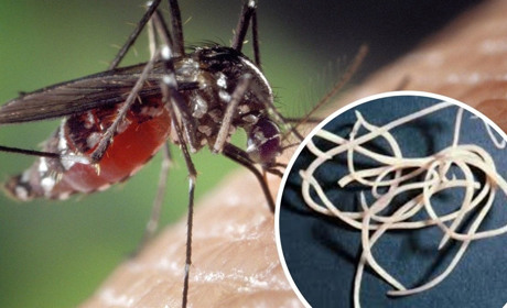 У Сарнах лікарі під шкірою пацієнтки знайшли 12-сантиметрового гельмінта