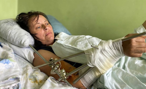 Мене засипало землею у воронці від ракети в Бахмуті. Я дивом вижила, тепер лікарі рятують мою ногу