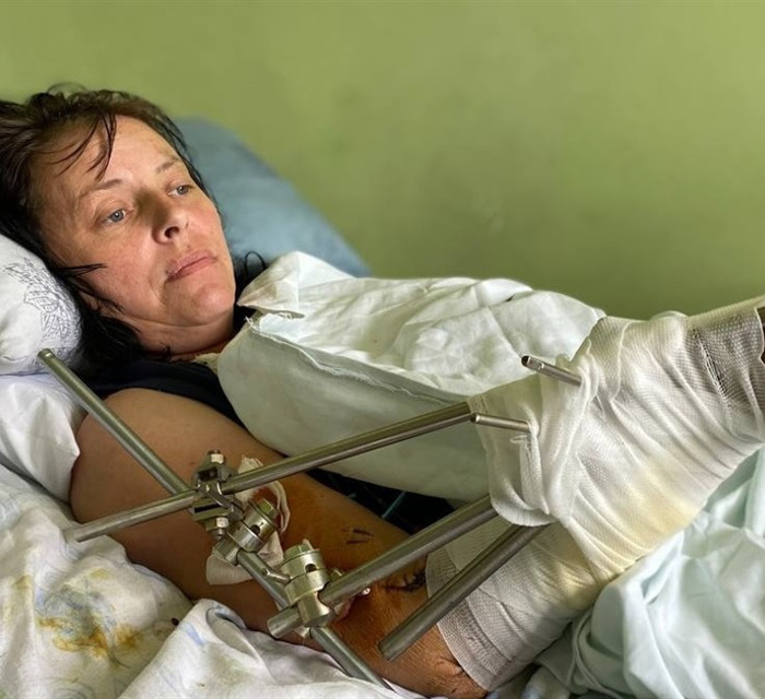Мене засипало землею у воронці від ракети в Бахмуті. Я дивом вижила, тепер лікарі рятують мою ногу