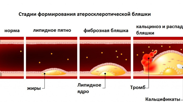 Что такое атеросклероз