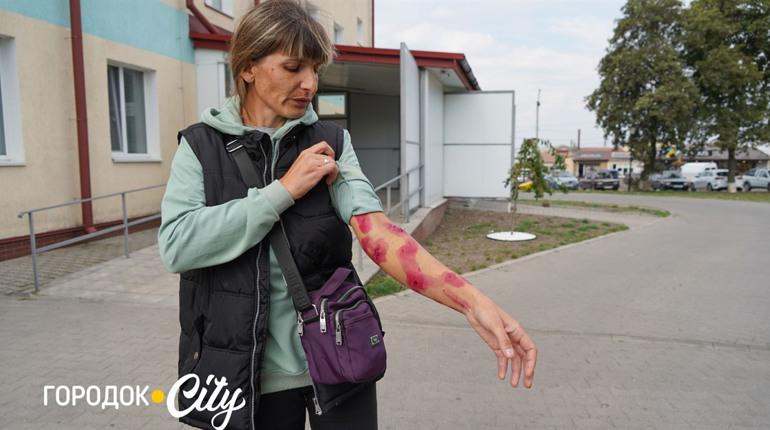 У Городку безпритульні собаки покусали жінку. Влада прокоментувала ситуацію