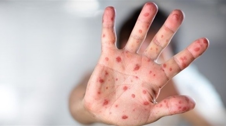 В Одесі двоє дітей захворіли на кір: не були вакциновані. Проводять заходи, щоб попередити спалах