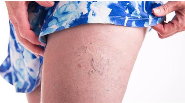 Мікроциркуляція крові та ламкість капілярів: що вам варто знати