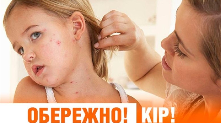 За півтора місяці 2019 року зафіксували більше випадків кору, ніж за весь 2018-й