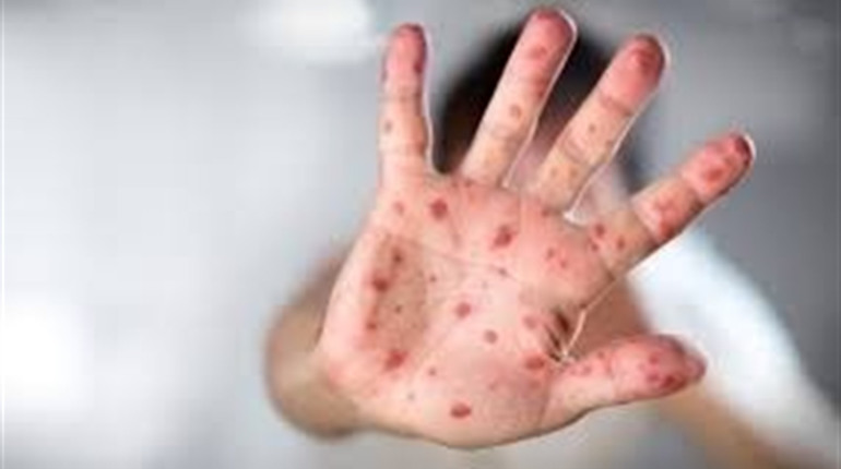 Випадки захворювання на кір в районі збільшились: Свіжі цифри