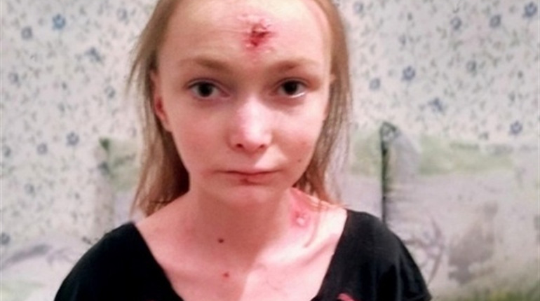 Помоги своим: 16-летняя Аня борется с неизлечимой болезнью и нуждается в помощи