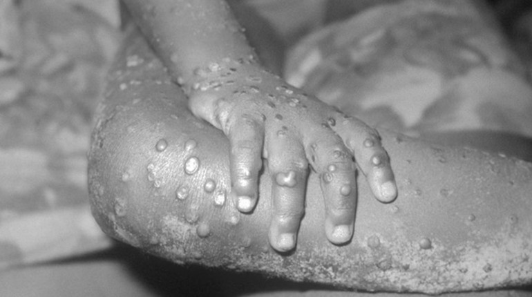 Віспа мавп: чи прийде хвороба в Україну і що про неї відомо