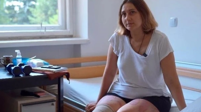 Жінці з Гуляйполя, що втратила ногу через обстріли, відновили можливість ходити