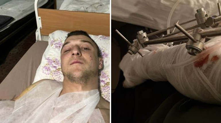 Відірвало руку: військовий із Сарн потребує коштів на реабілітацію