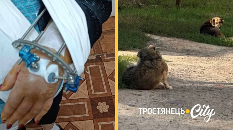 Скільки людей уже постраждало. Через напад собак мешканка Тростянця зламала руку і лежить у лікарні