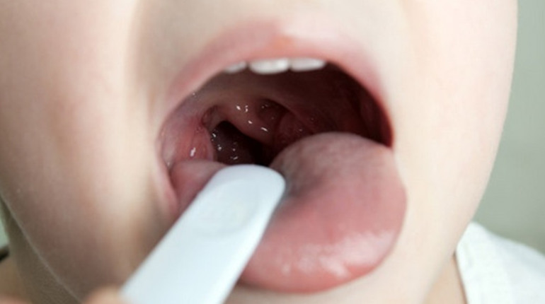 Видалення аденоїдів у дітей: показання, підготовка та відновлення