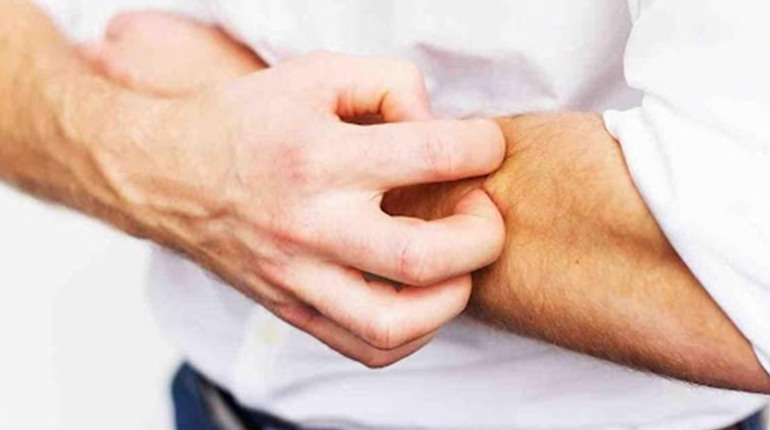 Що таке короста: симптоми, причини та ризики