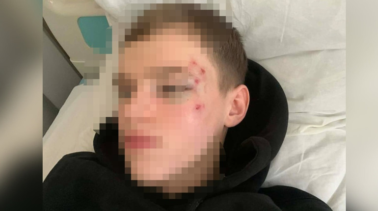 Побиття кастетом хлопця у Переяславі поліція перекваліфікувала на ушкодження середньої тяжкості