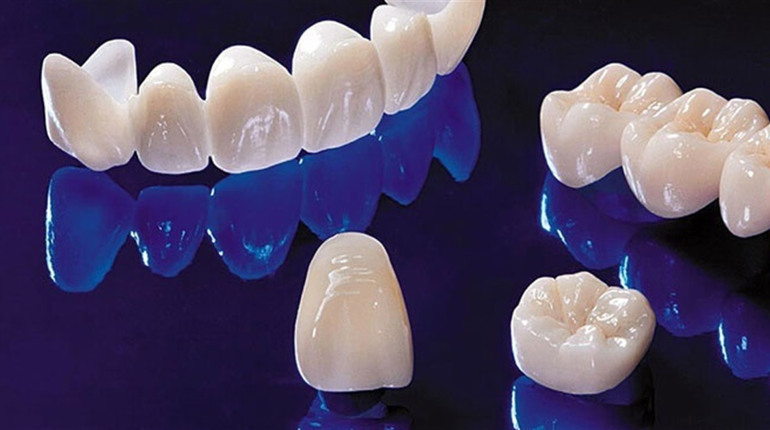 Металокерамічна коронка: бюджетне рішення з естетичним виглядом