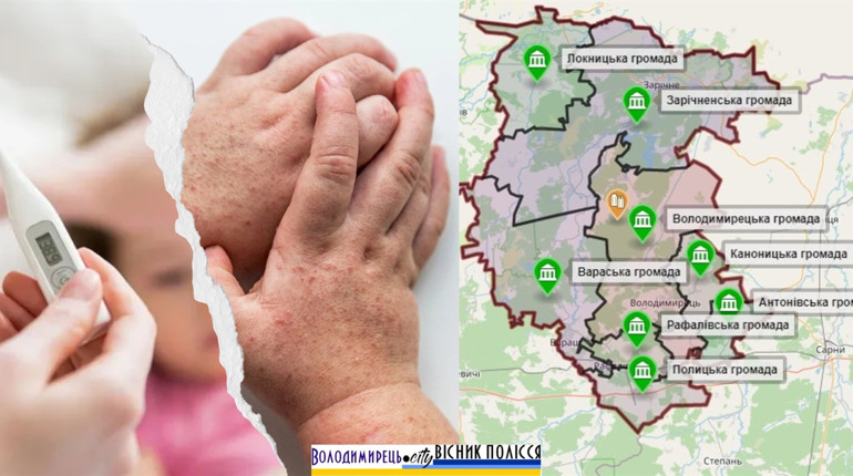 Статистика по скарлатині у Вараському районі зростає