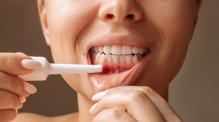 Етіологія бактеріальних інфекцій слизових оболонок