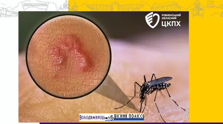 В чоловіка з Зарічного виявили великого підшкірного паразита