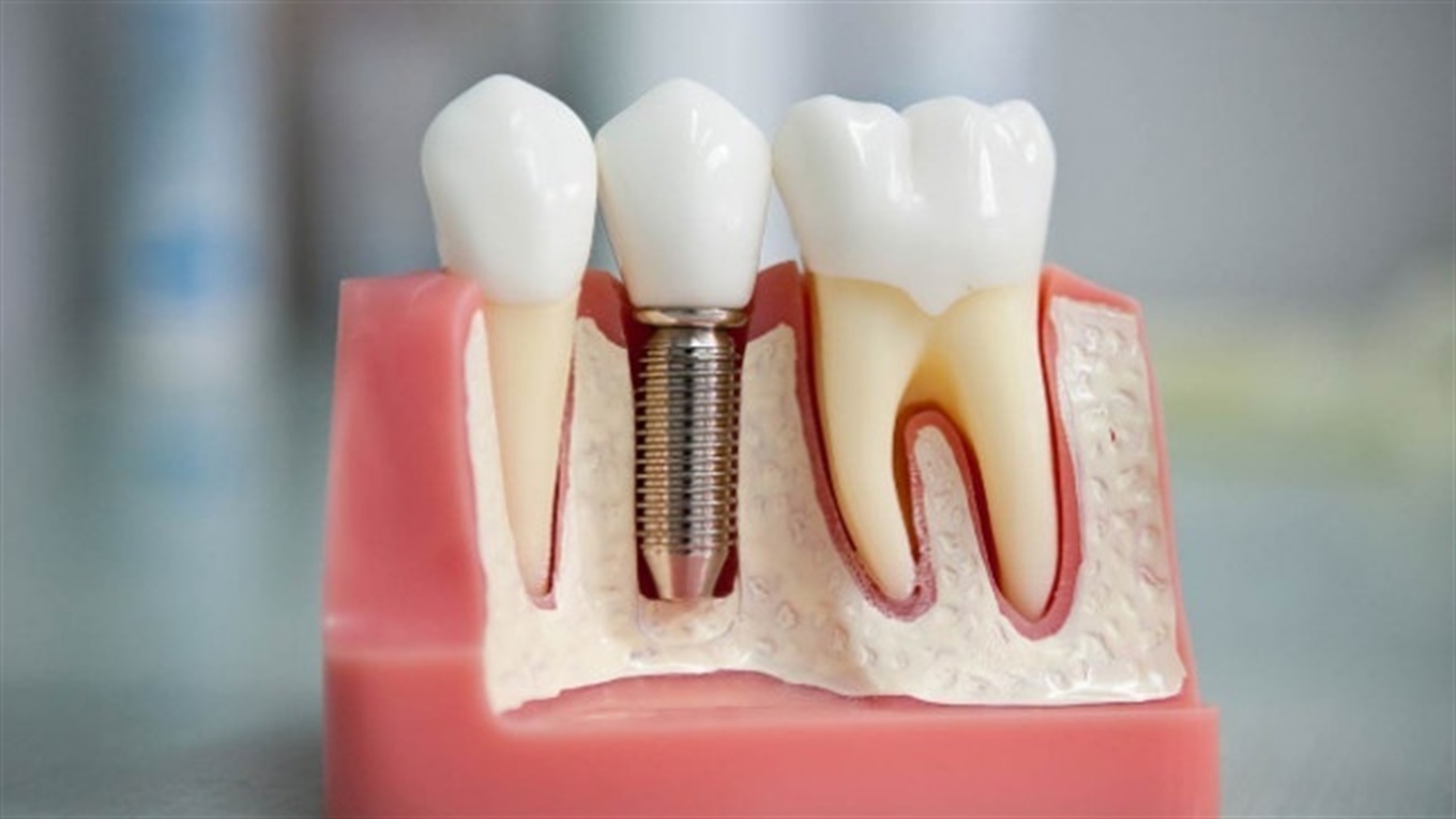 Що таке зубні імпланти, чи боляче їх ставити і як довго служитимуть –  БарNews.City