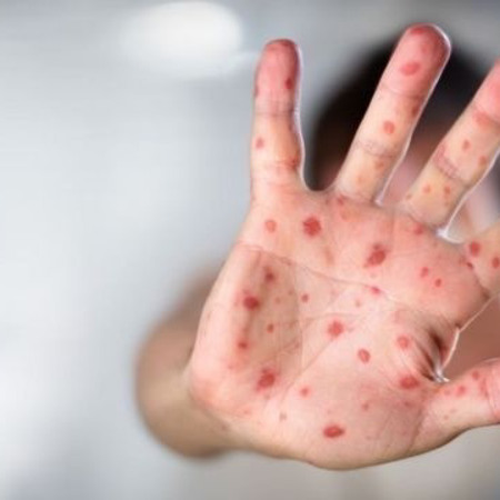 Кір, краснуха, паротит – щеплення КПК від розповсюджених інфекцій у дорослому віці