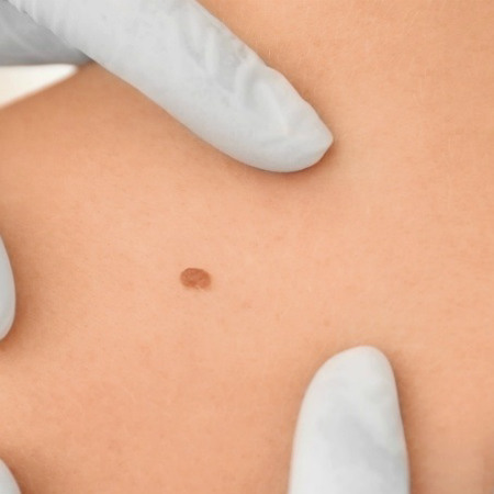 Щеплення проти вірусу папіломи людини (ВПЛ) 